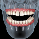 cum-se-desfasoara-procedura-de-implant-dentar-si-ce-trebuie-sa-stii-inainte-(p)