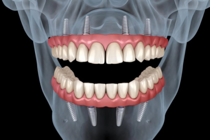 cum-se-desfasoara-procedura-de-implant-dentar-si-ce-trebuie-sa-stii-inainte-(p)