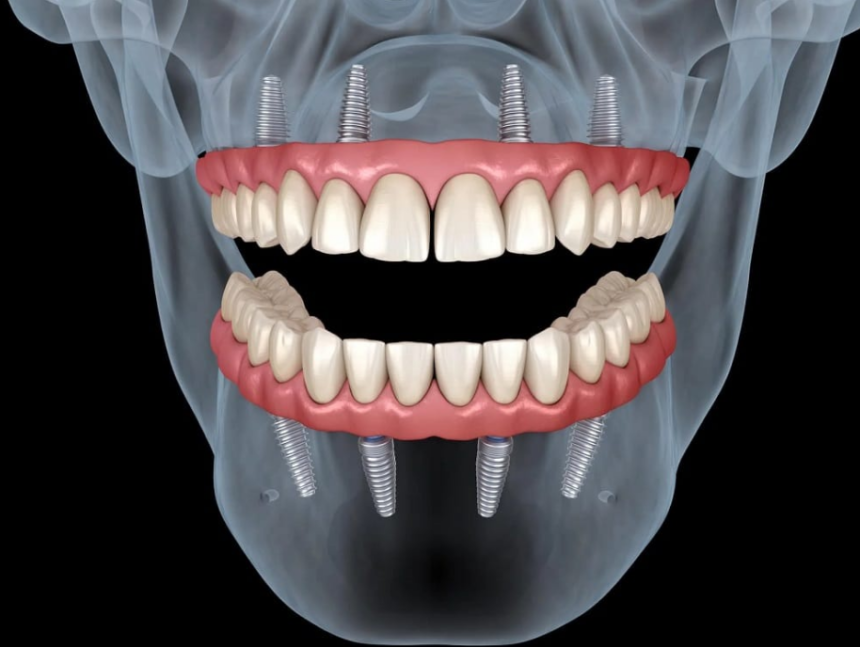 cum-se-desfasoara-procedura-de-implant-dentar-si-ce-trebuie-sa-stii-inainte-(p)