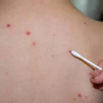 focar-de-rujeola-intr-o-mare-capitala-din-europa.-peste-60-de-copii-infectati,-medicii-sunt-in-alerta