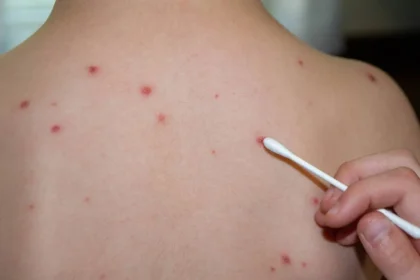 focar-de-rujeola-intr-o-mare-capitala-din-europa.-peste-60-de-copii-infectati,-medicii-sunt-in-alerta